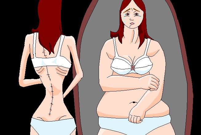 anorexia