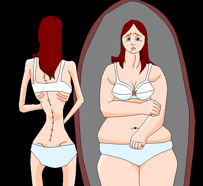 anorexia